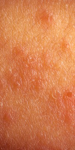 szifilisz_shutterstock_82754707_1332bda33c041840621584d452ed4003