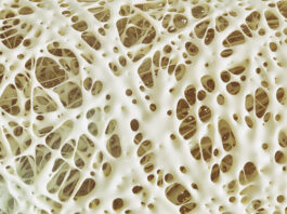 Nem törvényszerű az időskori csontritkulás – már fiatalon tehetünk a megelőzésért