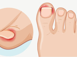 Benőtt köröm: nemcsak a szűk cipő a hibás – tévhitek és valóság