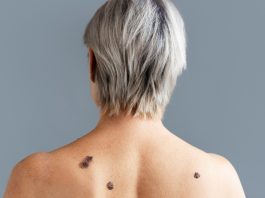 Otthon fagyasztott szemölcsök: 60%-uk kiújul