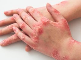 Télen súlyosbodnak a krónikus bőrbetegségek tünetei