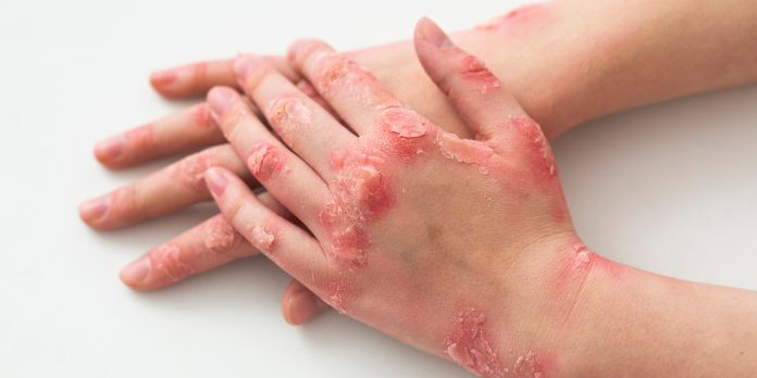 Télen súlyosbodnak a krónikus bőrbetegségek tünetei