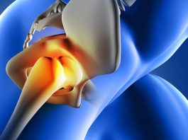 Csípőkopás, csípőfájdalom